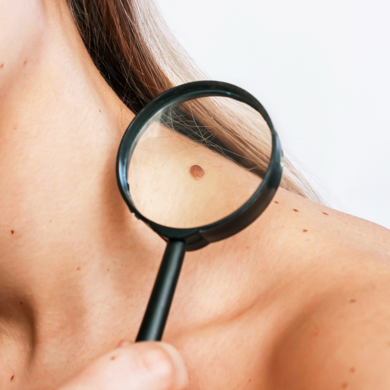 Diagnostic dermatologie skinmed, Roanne, Riorges, Mably, Le Coteau, Villerest, Perreux, Renaison, La Grande Pharmacie des Trois Grâces
